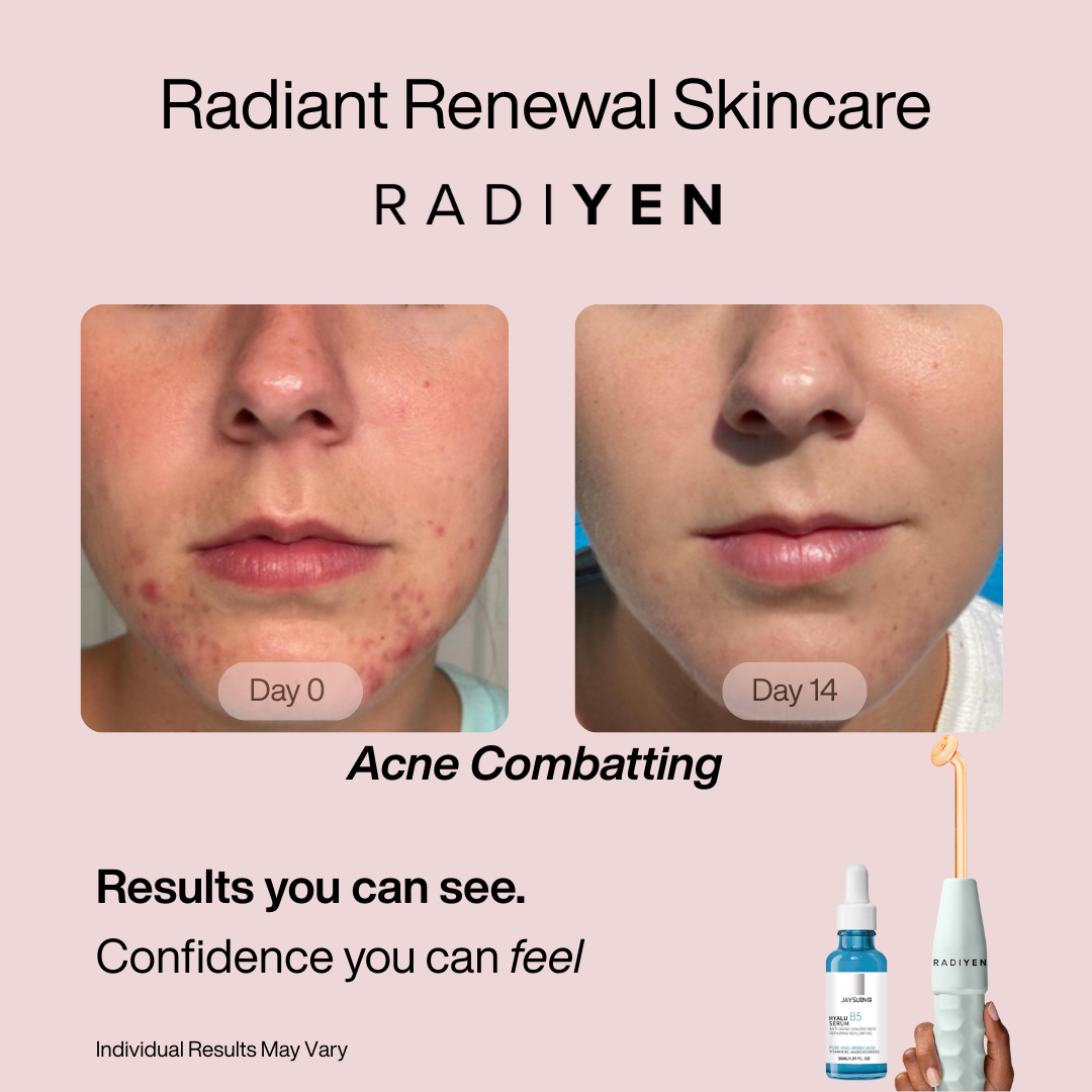 4-in-1 High Frequency Wand & Activating Serum Kit